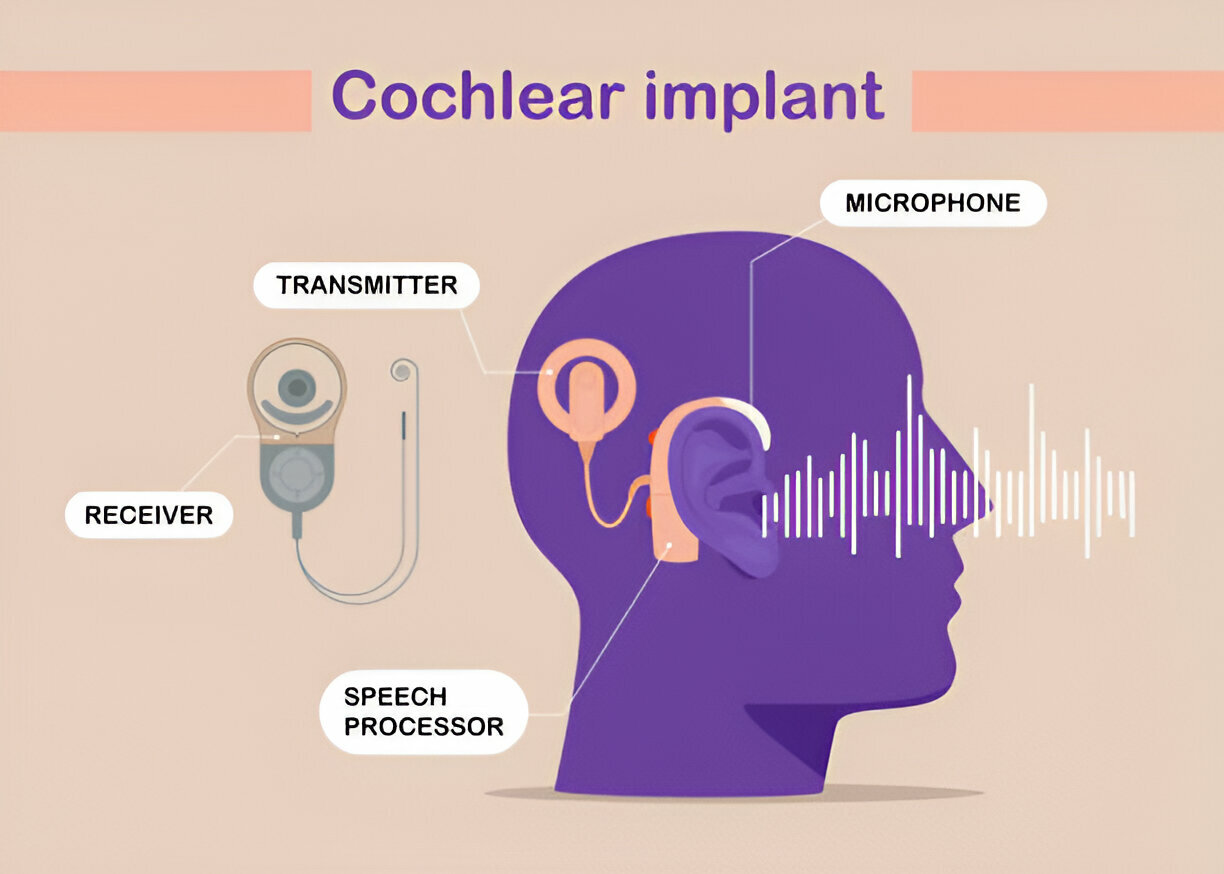 Benefits of Cochlear Implants